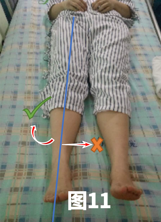 <!--HAODF:8:rengongguanjiezhihuanshu-->关节置换<!--HAODF:/8:rengongguanjiezhihuanshu-->的康复很重要：髋<!--HAODF:8:rengongguanjiezhihuanshu-->关节置换<!--HAODF:/8:rengongguanjiezhihuanshu-->手术后平常该如何锻炼？