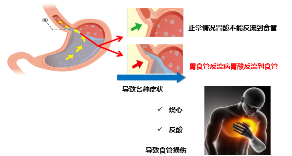 GERD1.png