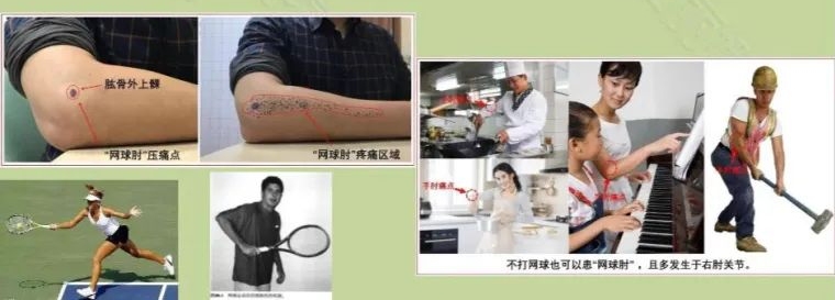 网球肘.jpg