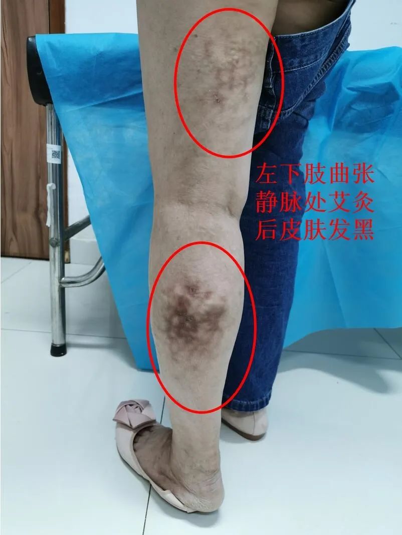 下肢静脉曲张，艾灸虽然感觉舒服，但要小心，避免中招