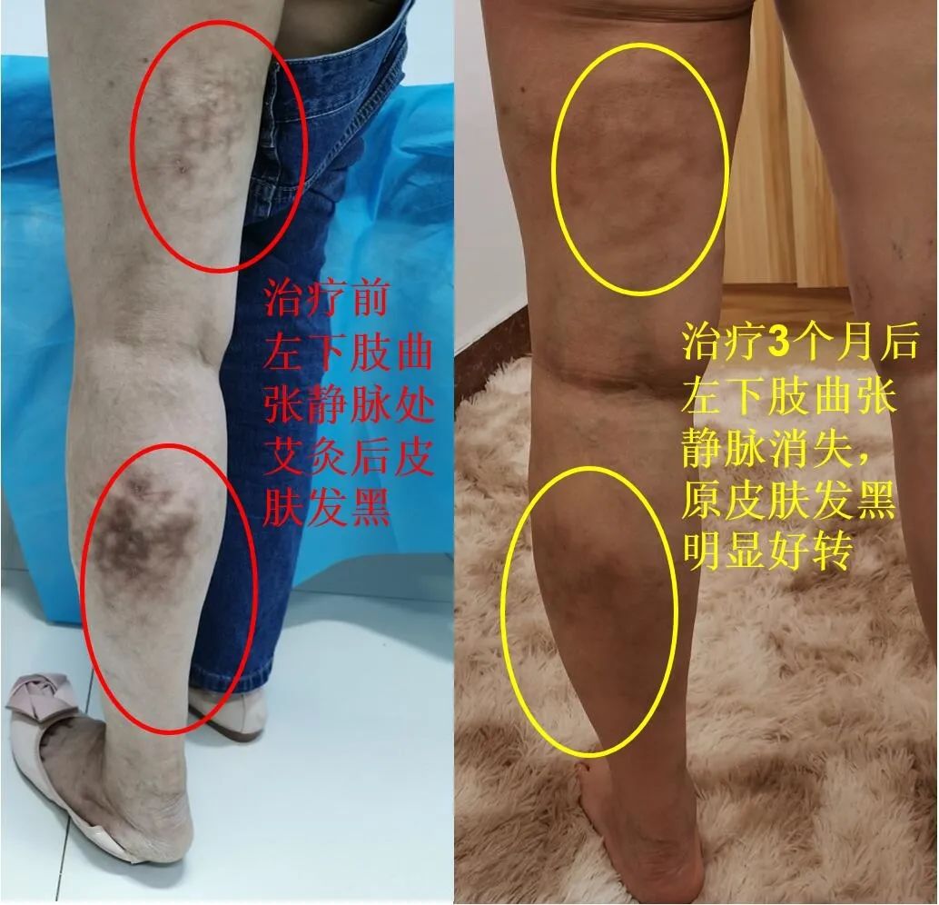 下肢静脉曲张，艾灸虽然感觉舒服，但要小心，避免中招