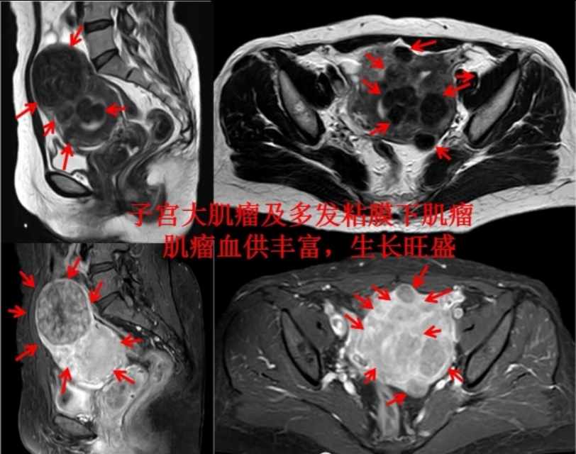 发现子宫肌瘤就要手术？成年女性得肌瘤几率多大？要正确认识肌瘤