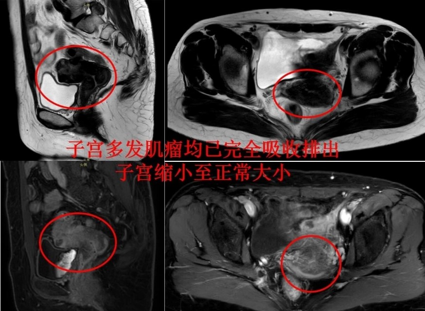 发现子宫肌瘤就要手术？成年女性得肌瘤几率多大？要正确认识肌瘤
