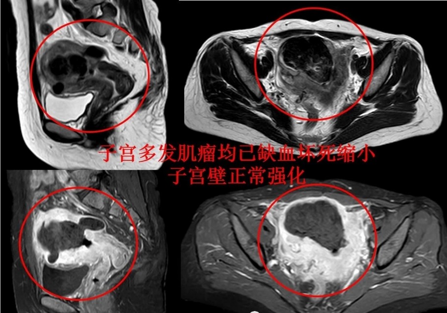 发现子宫肌瘤就要手术？成年女性得肌瘤几率多大？要正确认识肌瘤