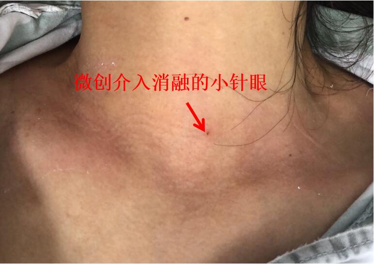 长期随访，看甲状腺结节是怎样消失的