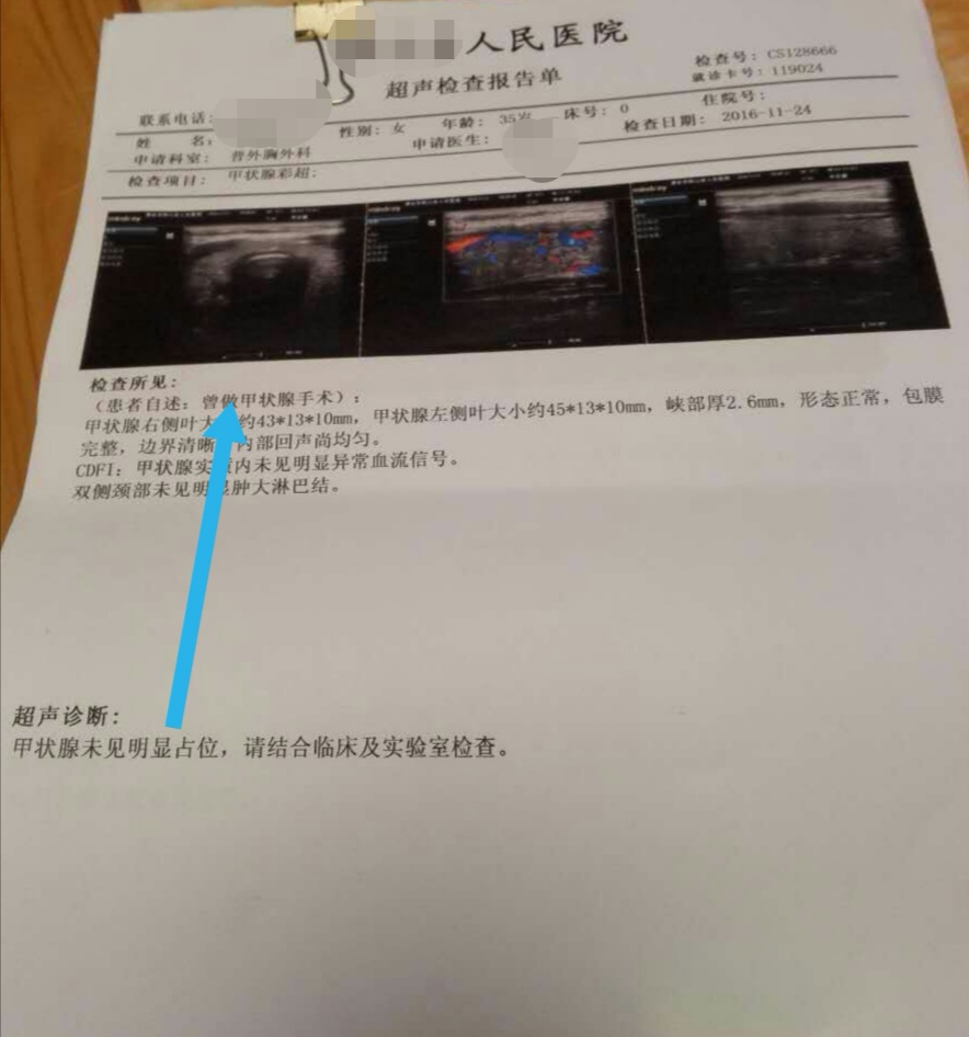 长期随访，看甲状腺结节是怎样消失的