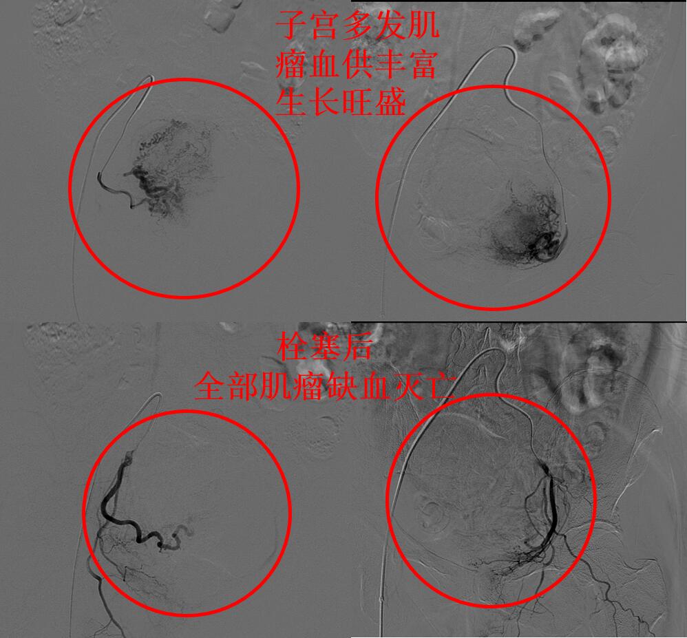 子宫多发肌瘤，哪种保宫治疗彻底，复发率最低？