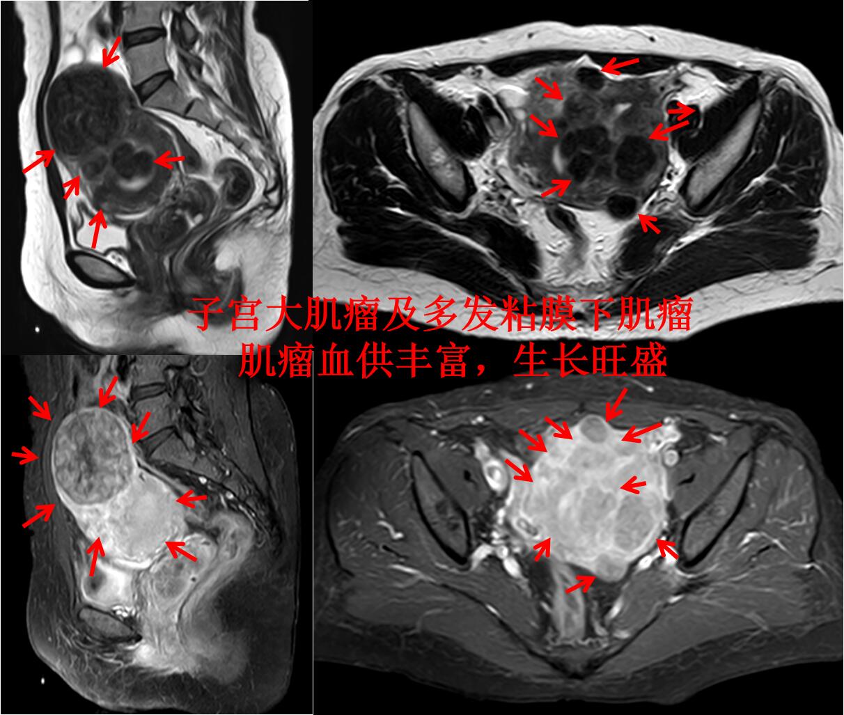 子宫多发肌瘤，哪种保宫治疗彻底，复发率最低？