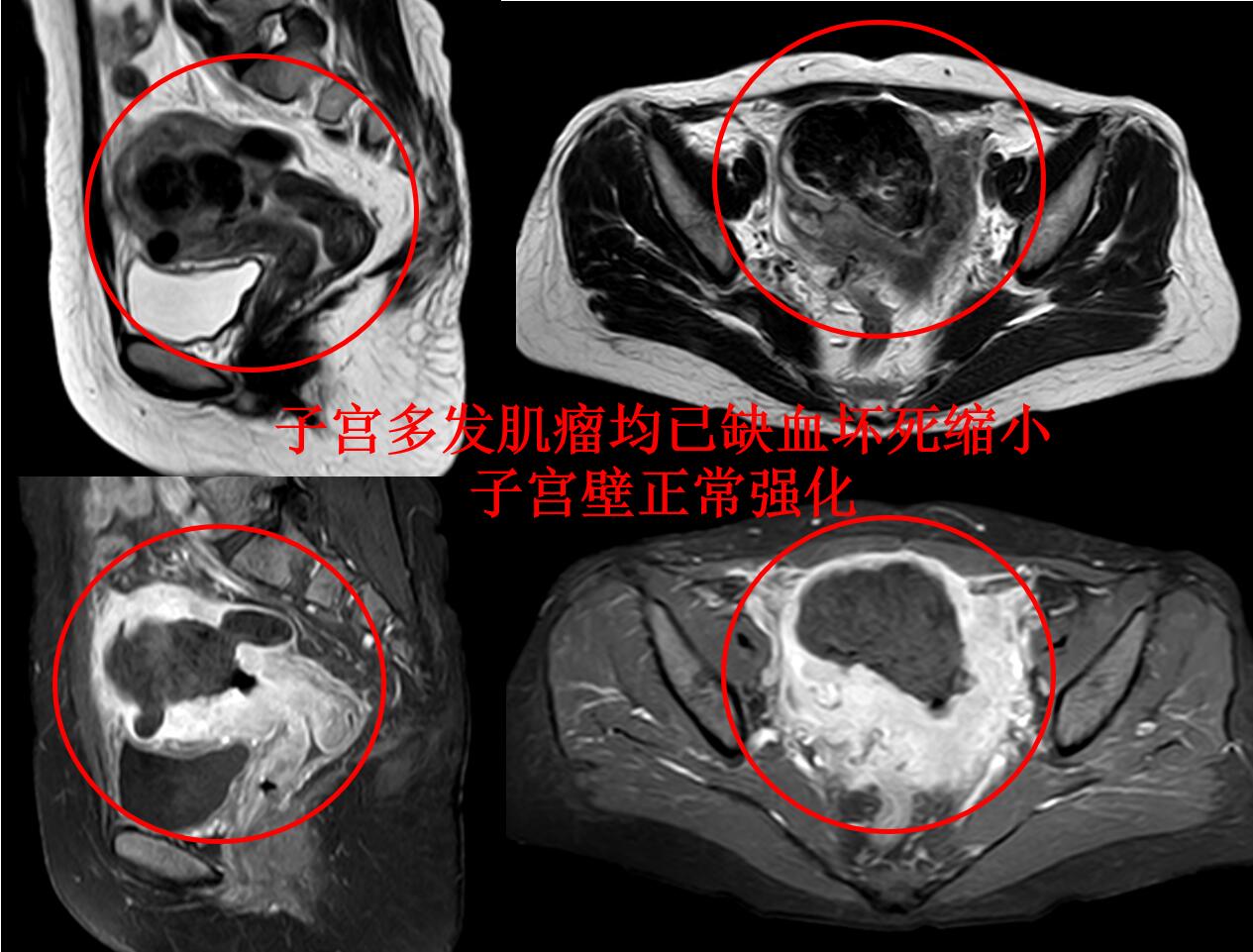 子宫多发肌瘤，哪种保宫治疗彻底，复发率最低？