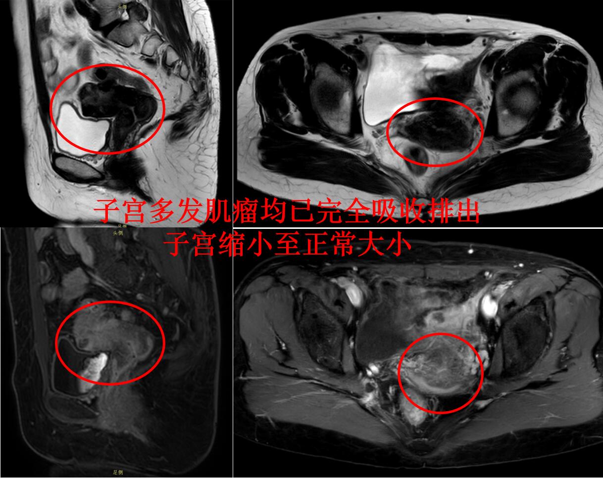 子宫多发肌瘤，哪种保宫治疗彻底，复发率最低？