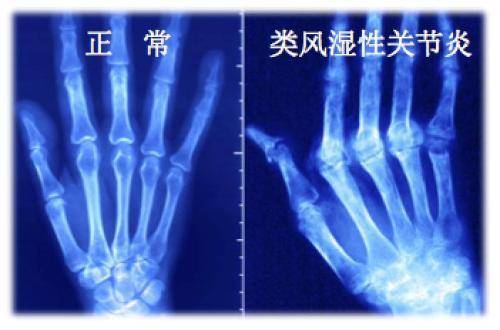关于不死的癌症——类风湿性关节炎，你想知道的都在这里