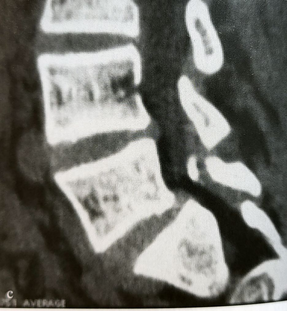 青少年脊椎滑脱伴脊柱侧凸：哪些情况需要手术干预？