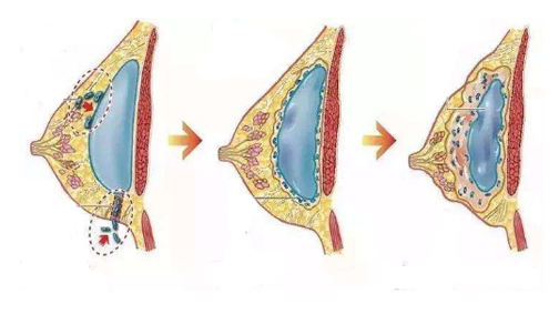 假体隆胸失败的图例图片