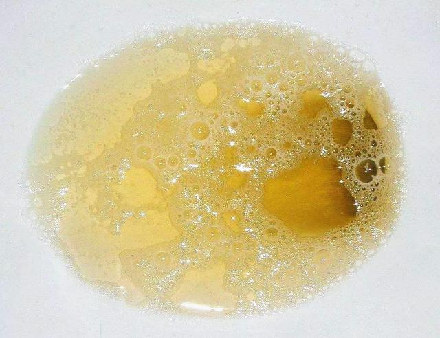 泡沫越多说明蛋白尿越严重吗?