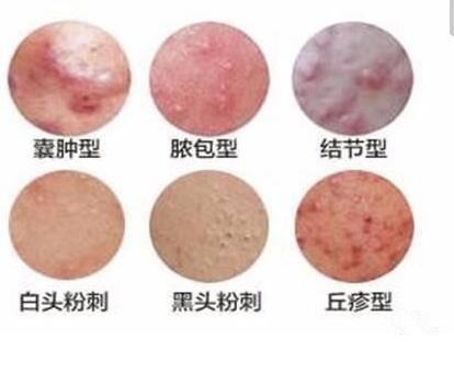 不想再反复长痘，可以试试这些中医药治疗方法