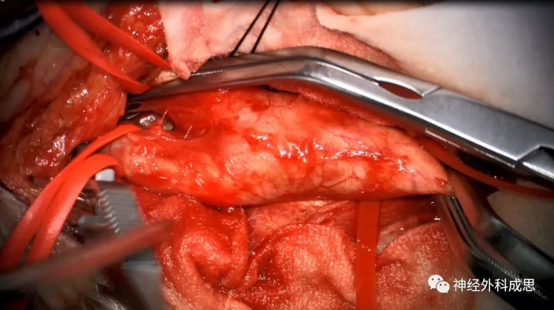 颈动脉内膜剥脱术我们到底在剥什么67