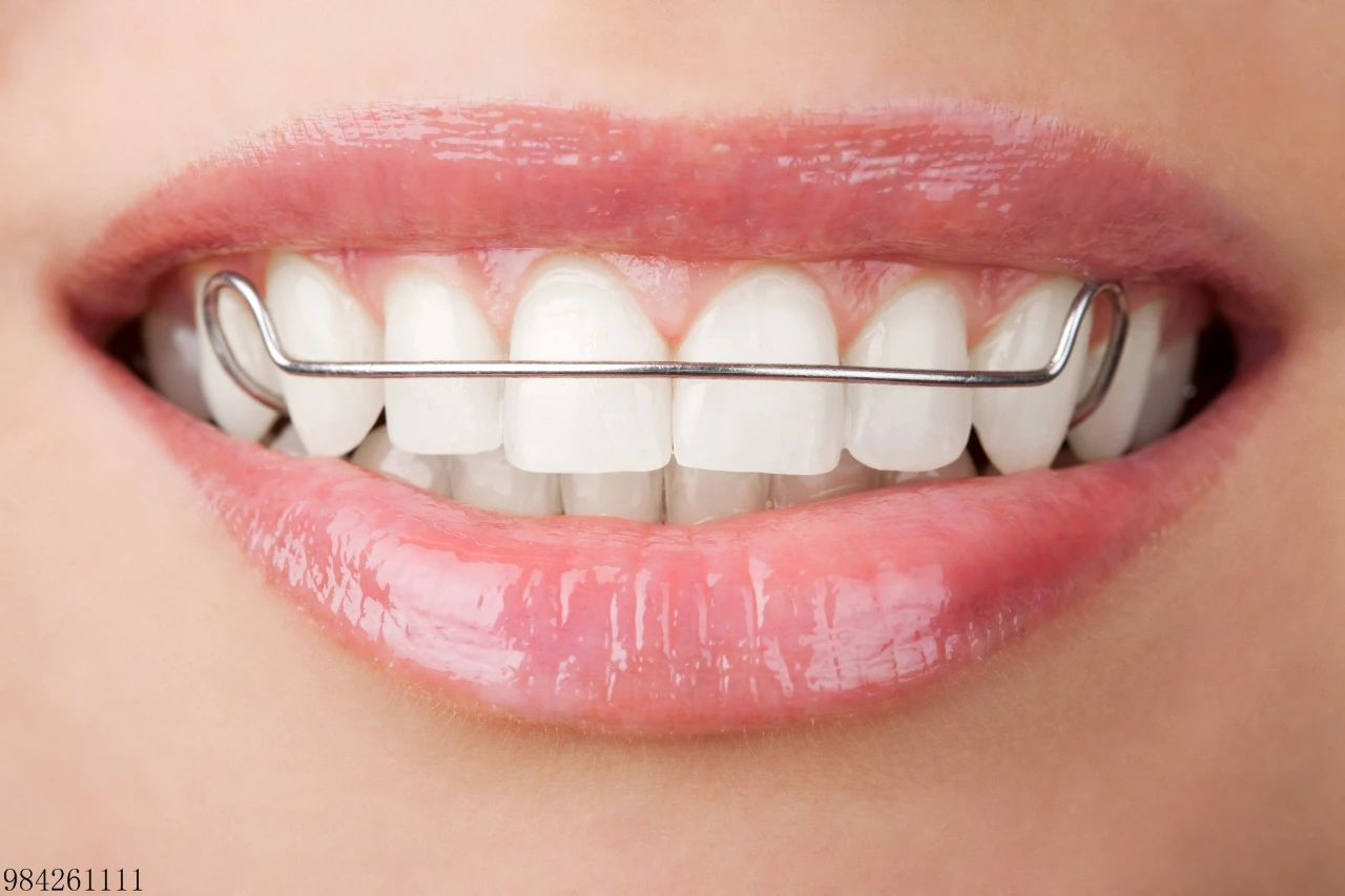 牙套有哪些种类?想要矫正的你怎么选?