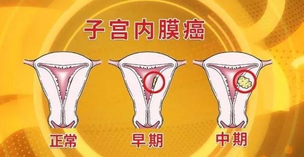 影响子宫内膜癌的预后因素