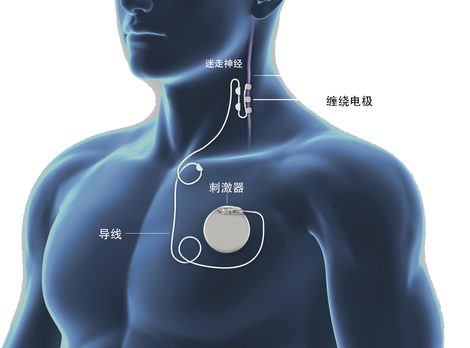 VNS示意图.png