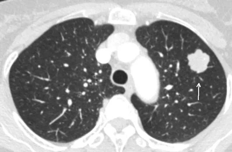 肺结节要不要手术切除
