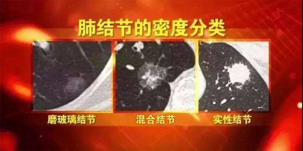 肺结节要不要手术切除