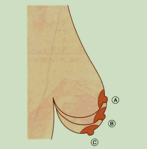 乳房下垂分类.PNG