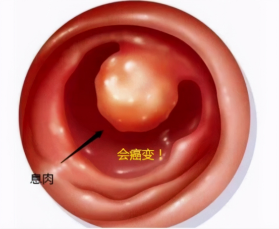 子宫内膜息肉长啥样图片