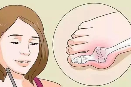 从罕见到常见：30岁的女性痛风患者