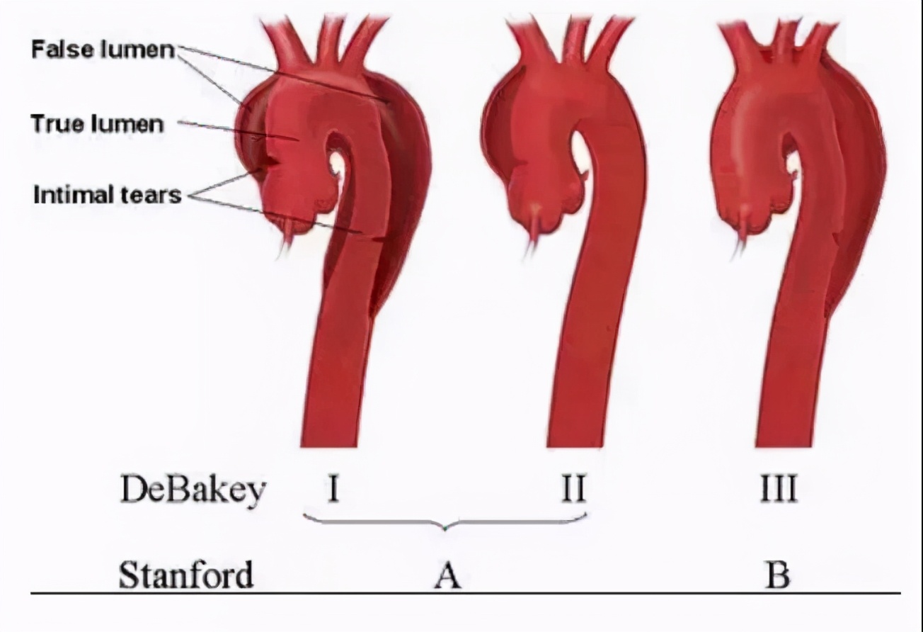 stanford分型图片