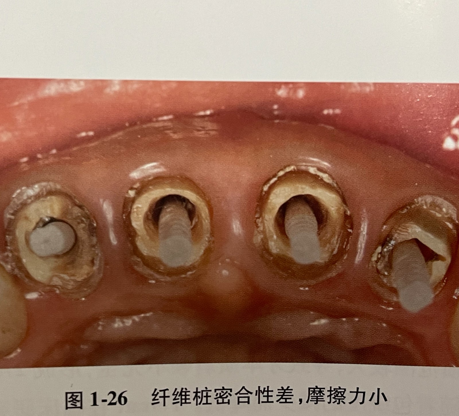 牙科成品桩图片