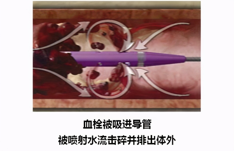 大叔肺动脉栓塞入院急救！险！原来是“它”引起的并发症