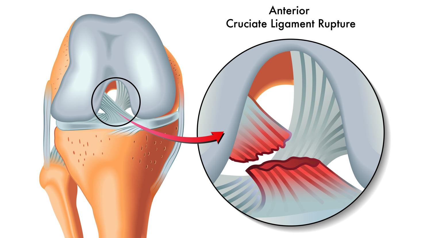cc_08_medium_acl.jpg