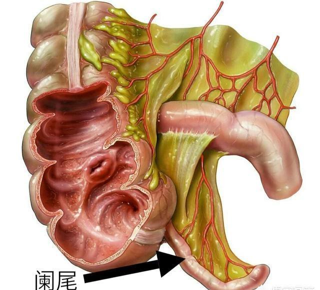 不容小觑的小儿急性阑尾炎