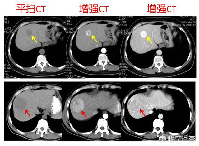 這麼說吧,增強ct可以看到普通ct看不到的小病灶,如果只做普通的ct的話