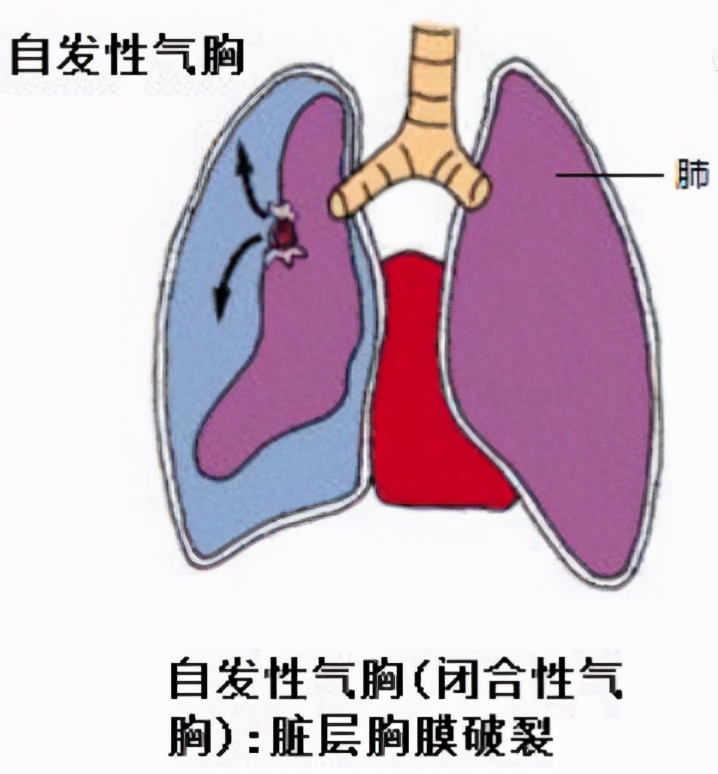 三种气胸的比较图图片