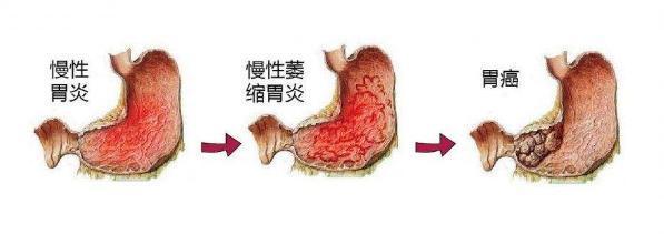 萎缩性胃炎.jpeg