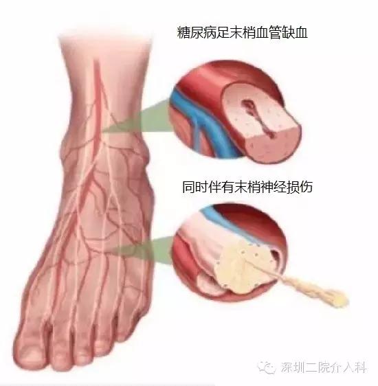 糖尿病足合并下肢动脉硬化闭塞症的血管介入治疗