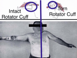 Rotator-Cuff-Tear-300x226.png