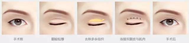全切双眼皮手术示意图