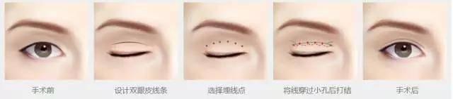 埋线双眼皮手术示意图