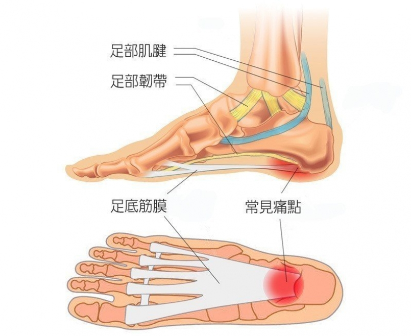 患上足底筋膜炎容易让你寸步难行，三招帮你摆脱困扰