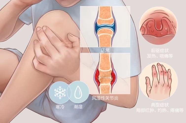 风湿性与类风湿性关节炎，虽然只有一字之差，但这些区别要了解