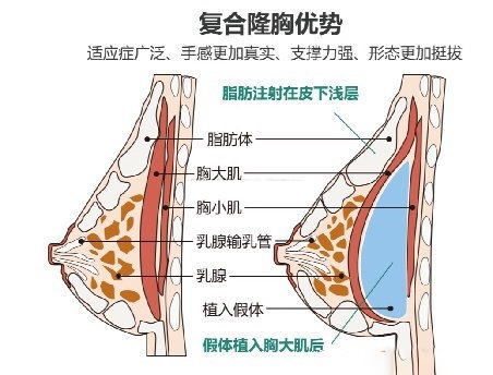 复合隆胸优势.png