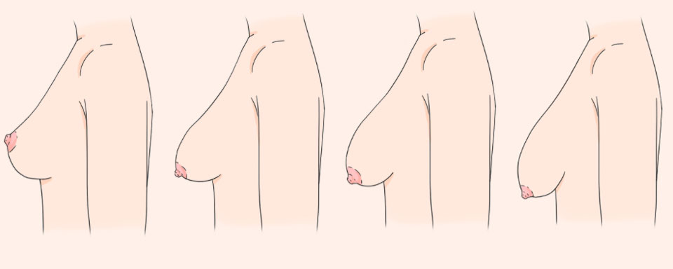 乳房下垂示意图.jpg