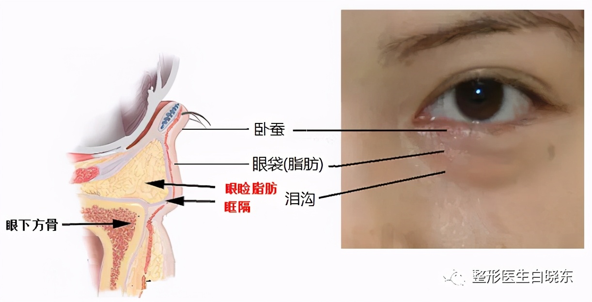 眼袋示意图图片