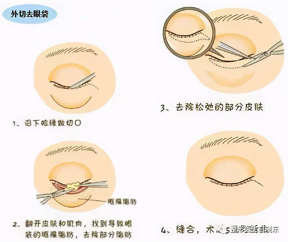 眼袋催人老，长眼袋怎么办？