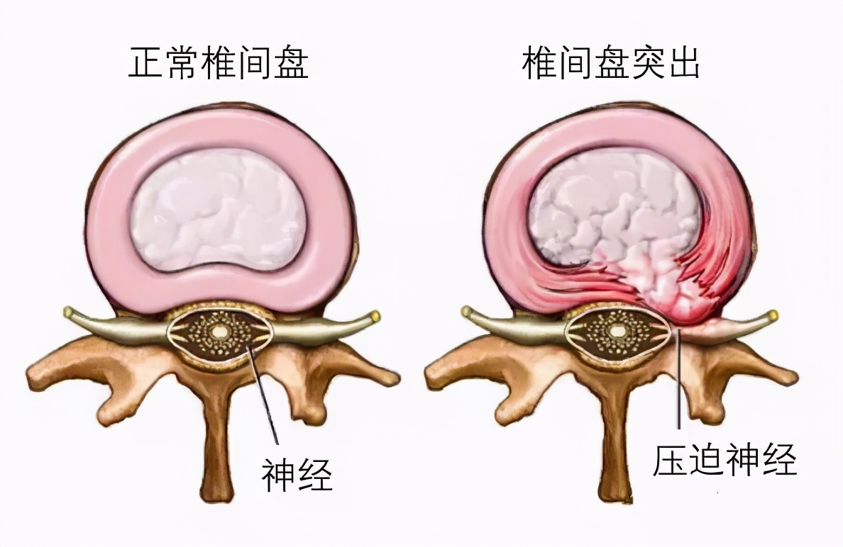 久站后腰痛是什么原因，时间越久越疼！医生：多见于这种情况