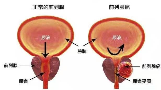 前列腺癌示意图.jpg