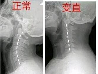 颈椎变直.jpg
