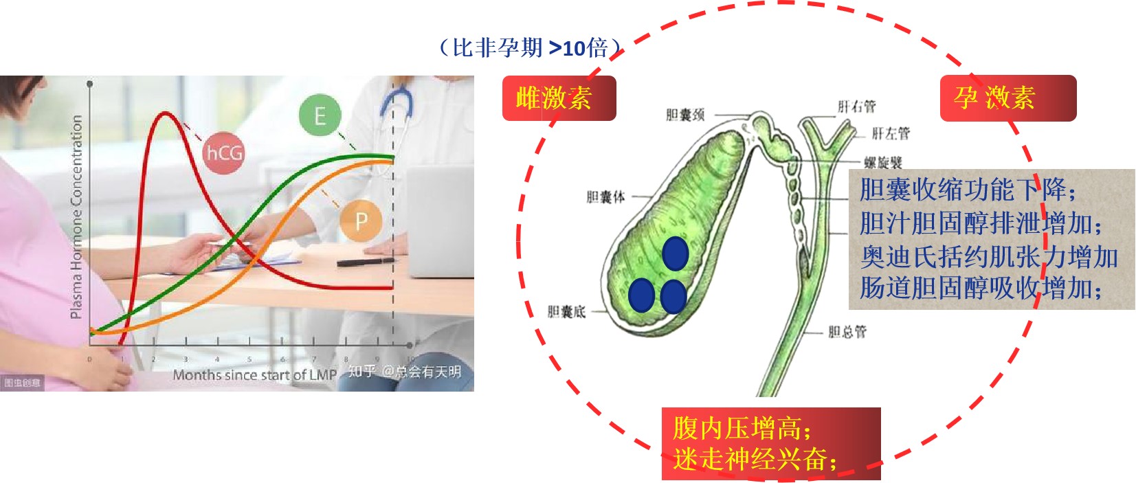 妊娠诱发胆囊结石原因.jpg